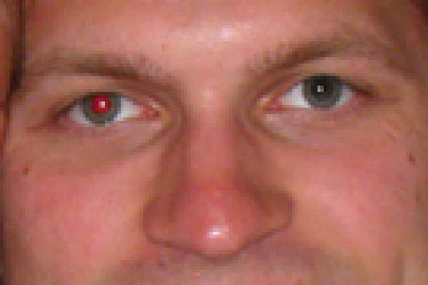 Red eye in one eye has been removed
